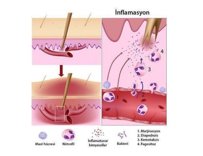 İnflamasyon, Yangı, İltihaplanma nedir? Kanserle İlişkisi Nasıldır?