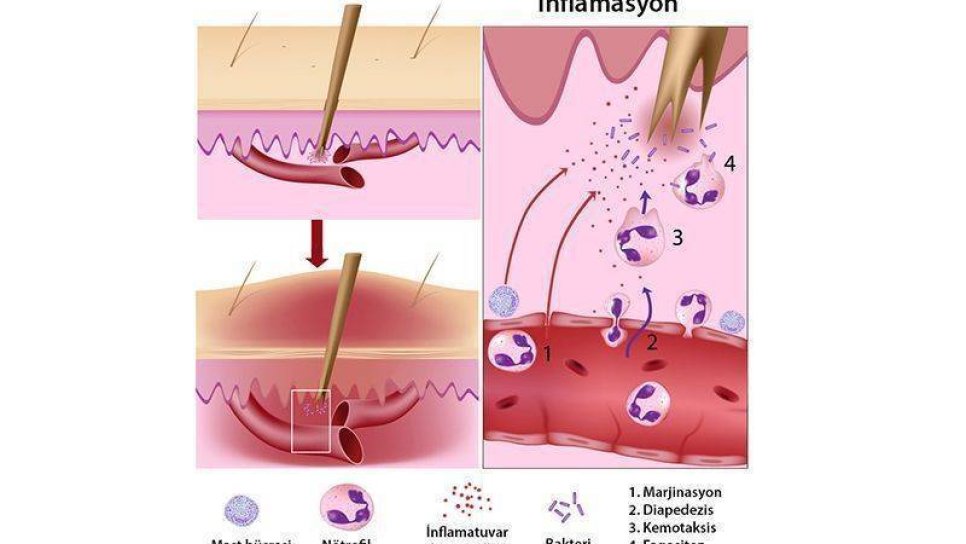yabanci cisim igne batmasi sonucu gelisen dissal inflamatuvar yanit yangi