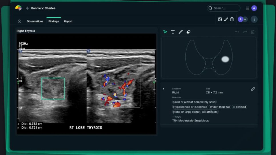 FDA-Freigabe für KI-gestützte Schilddrüsen-Ultraschallsoftware – Neue Ära der Radiologie