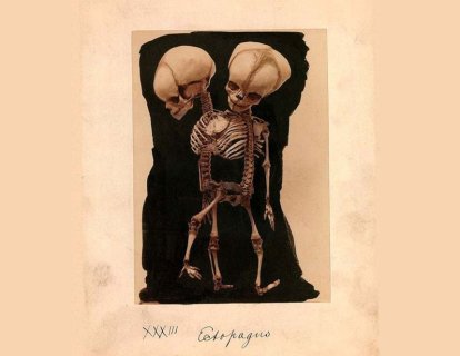 Yapışık İkizlerin Ayrılması 1689