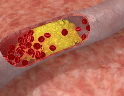 Kolesterol Değerleri HDL, LDL, Trigliserid Nedir? Yaşa Göre Düzeyleri Ne Olmalı?