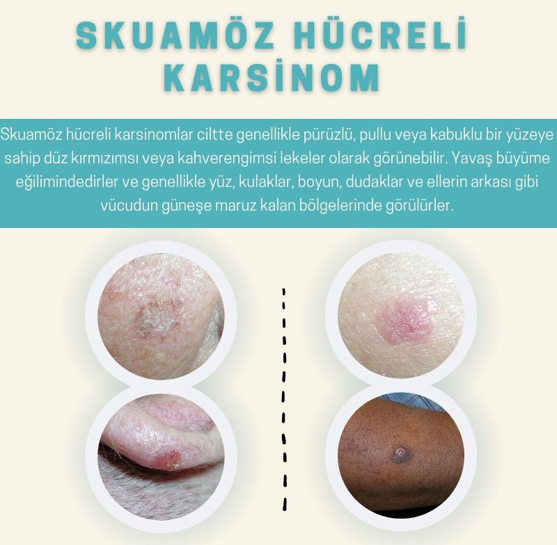 عکسهای کارسینوم سلول سنگفرشی