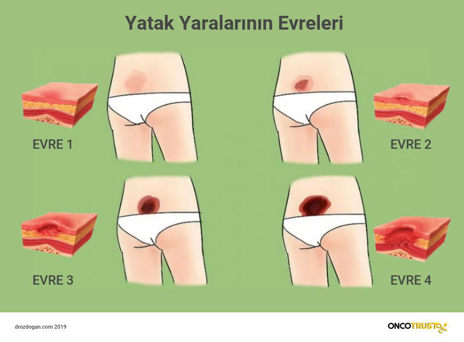 yatak yaralarinin evreleri 930779
