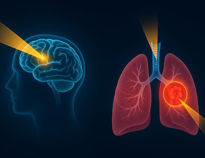 Yaygın Evre Küçük Hücreli Akciğer Kanseri: Beyne ve Ana Tümör Alanına Koruyucu Radyoterapi