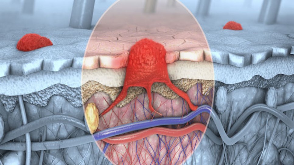 Yeni Bir İmmünoterapi Kanser Tedavilerinde Fark Yaratabilir: Anti-LAG-3 Relatlimab