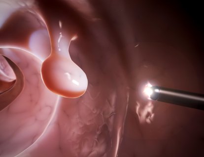 Yeni bir kan testi, kanser öncesi kalın bağırsak adenomlarını tespit ediyor