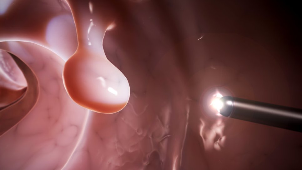 A New Blood Test Detects Precancerous Colorectal Adenomas