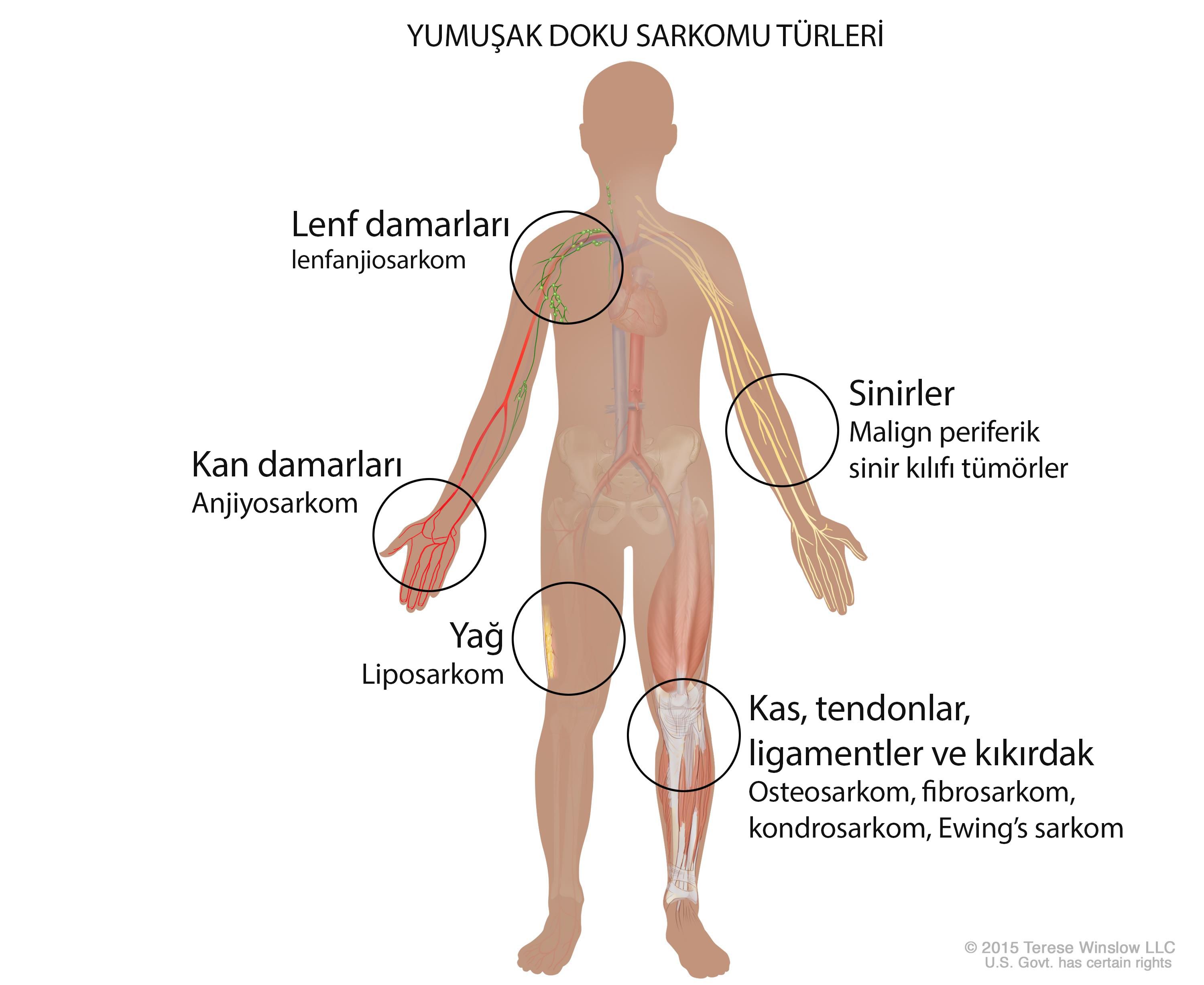 yumusak doku sarkomu turleri cesitleri 987972