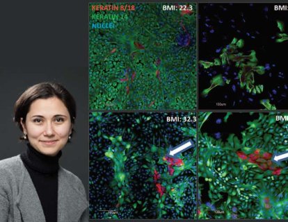 Kandaki Serbest Yağ Asitlerinin Meme Kanseri Büyümesini Desteklediği Keşfedildi