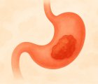 Zolbetuximab-clzb (Vyloy) Nedir? FDA Onayı, Türkiye Ruhsatı ve Geri Ödeme Durumu