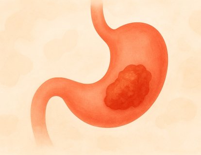 Zolbetuximab-clzb (Vyloy) Nedir? FDA Onayı, Türkiye Ruhsatı ve Geri Ödeme Durumu