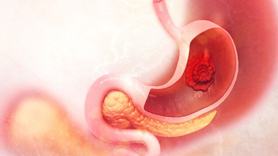 Zolbetuximab ilə HER2-neqativ mədə xərçənginin müalicəsində yeni dövr