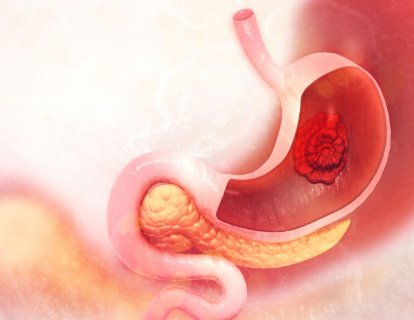 Zolbetuximab ile HER2-Negatif Mide Kanseri Tedavisinde Yeni Bir Dönem