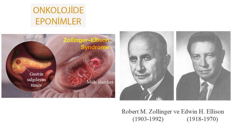 Zollinger Ellison Sendromu Nedir Adı Nereden Gelmektedir