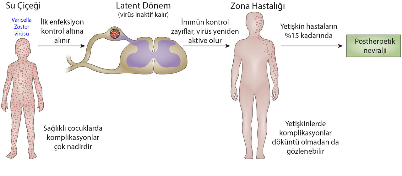 ce este zona zoster herpes zoster cum apare arsură nocturnă boala cingătorii varicelă PHN