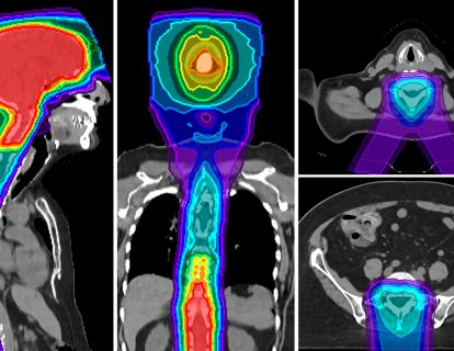 Zor Bir Alan, Güçlü Kanıt: Leptomeningeal Metastazda Proton Radyoterapi