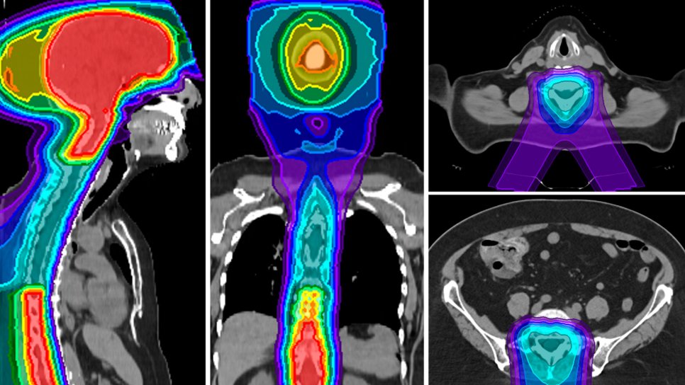 Zor Bir Alan, Güçlü Kanıt: Leptomeningeal Metastazda Proton Radyoterapi