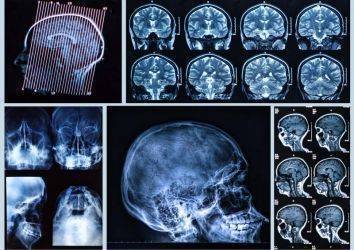 4. Evre Baş ve Boyun Kanserleri Tedavisi için Nivolumab Adlı İmmünoterapi İlacı FDA Onayı Aldı