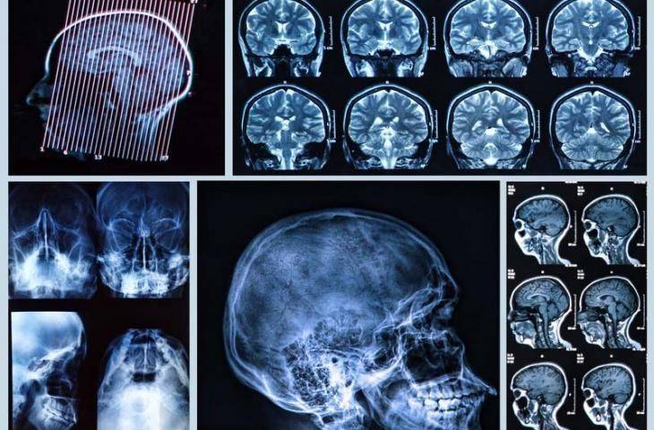 4. Evre Baş ve Boyun Kanserleri Tedavisi için Nivolumab Adlı İmmünoterapi İlacı FDA Onayı Aldı