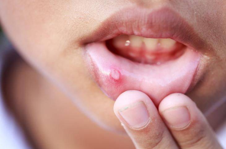 Kanser hastasında ağız yarası - oral mukozit | Prof. Dr. Mustafa ÖZDOĞAN