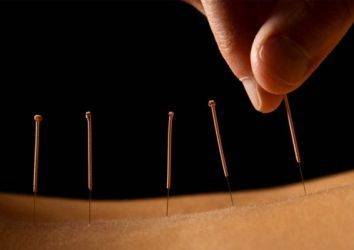 Akupunktur meme kanserinde lenfödemi azaltabilir