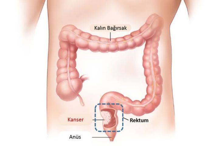 Ameliyatsız rektum (makata yakın kalın barsak) kanseri tedavisi mümkün mü?