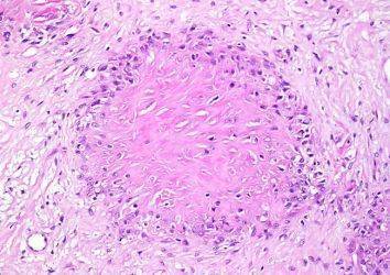 Düşük Dereceli Fibromiksoid Sarkom – Low Grade Fibromyxoid Sarcoma