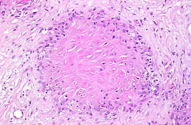 Düşük Dereceli Fibromiksoid Sarkom – Low Grade Fibromyxoid Sarcoma