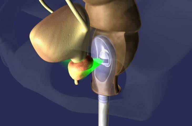 Prostat Kanserinin Ameliyatsız Tedavisinde Yeni Bir Yöntem Onayladı: HIFU