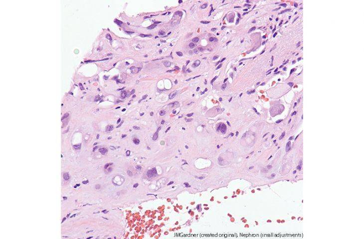 Epiteloid Hemanjioendotelyoma nedir? Belirtileri, tedavisi ve hastalık gidişatı