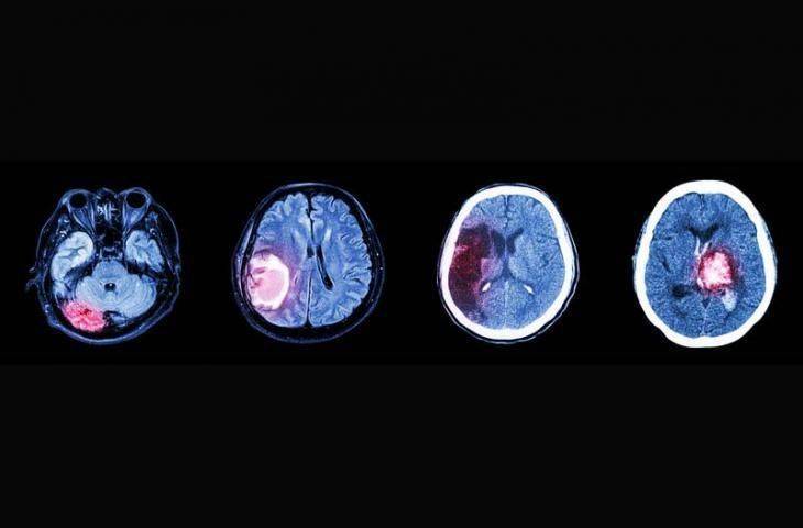 Gliomlar (GBM) ve Non-glial tümörler