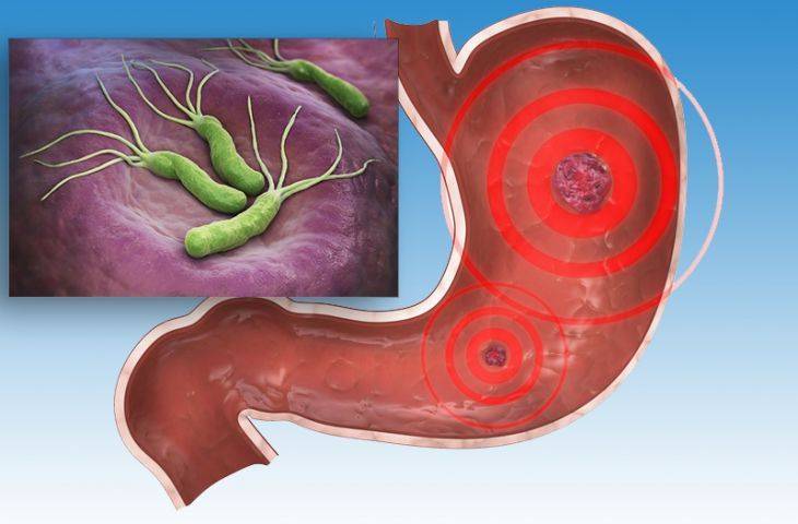 Helikobakter pilori enfeksiyonu tedavisi ile mide kanserinden korunma