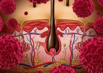 İleri Evre Melanomda Nivolumab ve İpilumumab’ın Birlikte Kullanımı Daha Avantajlı Olabilir Mi?