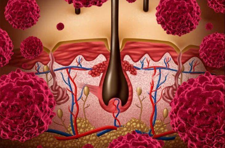 İleri evre melanomda nivolumab ve ipilumumab’ın birlikte kullanımı daha avantajlı olabilir mi?