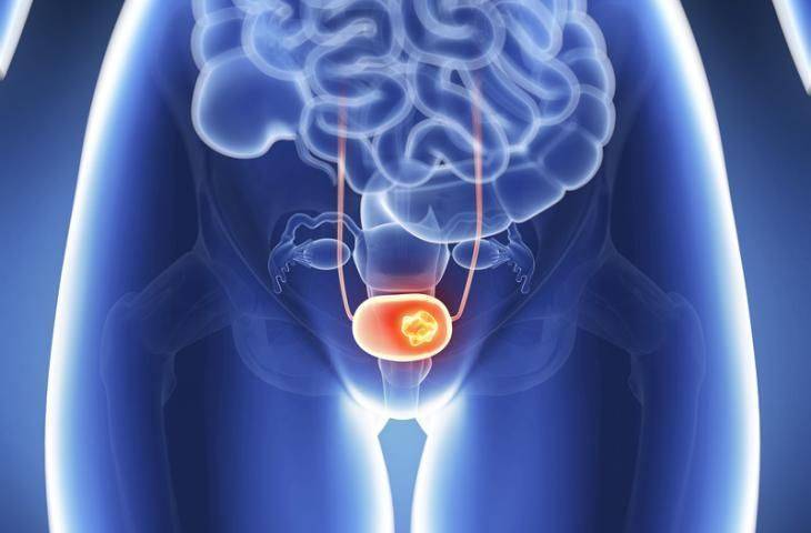 İmmünoterapi ilacı Atezolizumab, mesane kanseri tedavisi için FDA onayı aldı