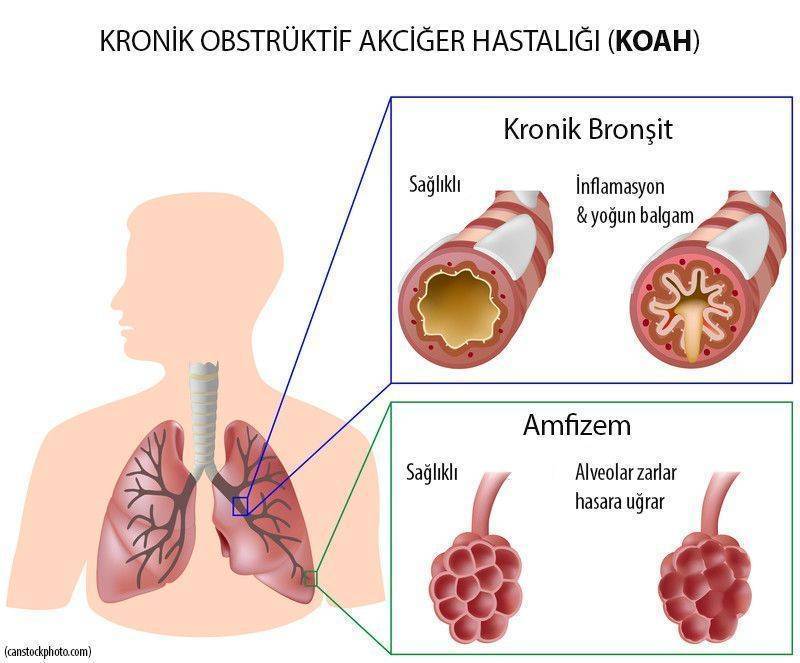 KOAH kronik obstrüktif tıkayıcı akciğer hastalığı 1