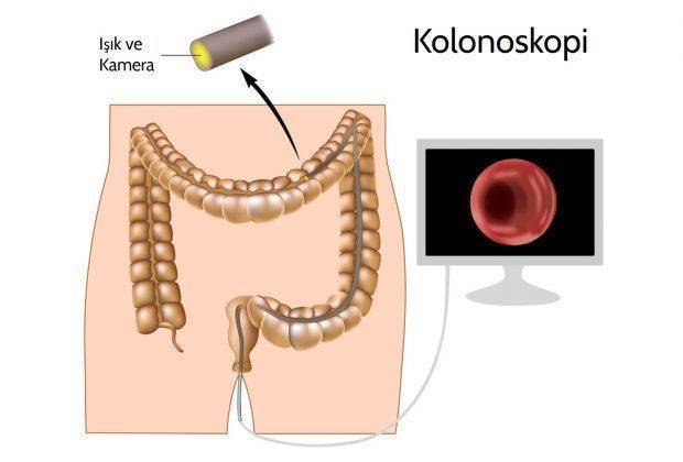 Kalın bağırsak kolon ve rektum kanserlerinde erken tanı ve tarama mümkün müdür Kolonoskopi 