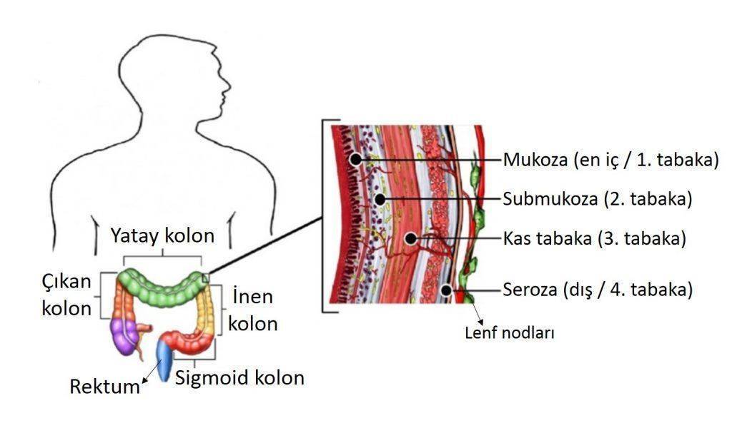 Kalın bağırsak kolon ve rektum kanserlerinde hastalık aşamaları evreler 1024x628