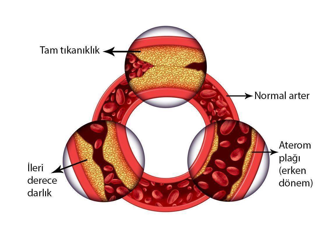 Kalp damar hastalığı nedir Risk faktörleri nelerdir