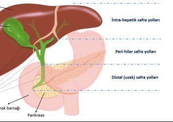 Kanser Türlerine Göre Tanı ve Tedavi Bölümüne Safra Yolu Kanserleri (Kolanjiokarsinomlar) Eklendi