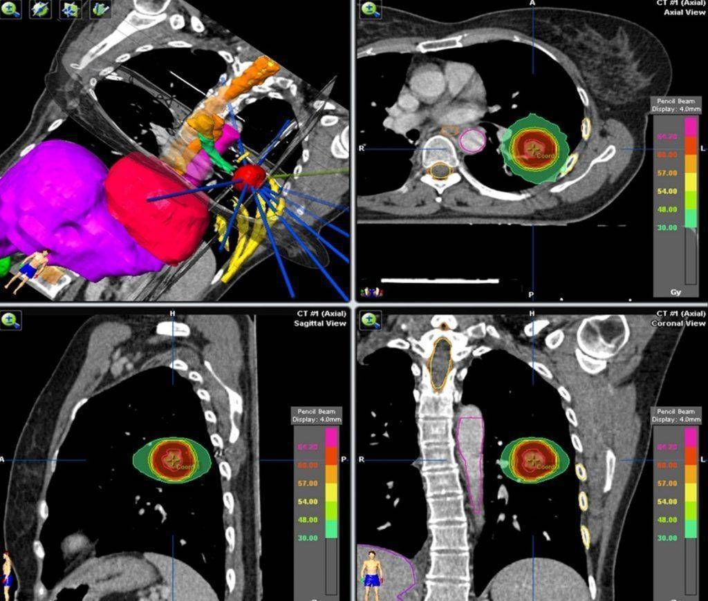 Küçük akciğer tümörlerinin sterotaktik vücut radyoterapisi SBRT ile tedavisi