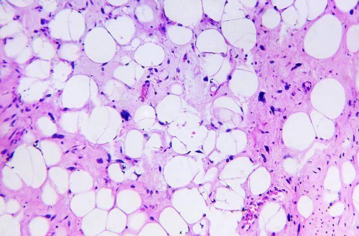 Liposarkom tanılı hastalarda yeni bir ilaç, yaşam sürelerini uzattığı için Amerikan Gıda ve İlaç Dairesi (FDA) onayı aldı
