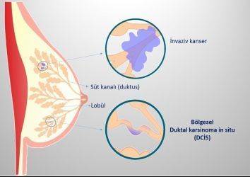 Meme kanserinin bir türü olan düşük-gradlı duktal karsinoma in situ tedavisinde ameliyat yerine aktif takip!
