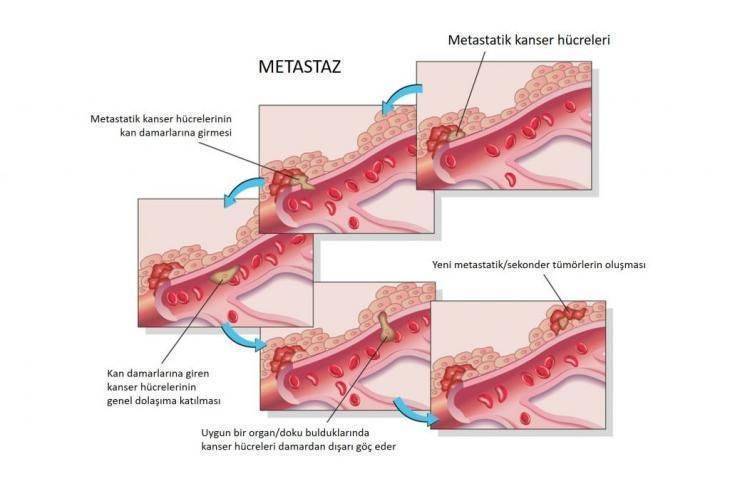Metastaz nedir – kısaca – kanser nasıl yayılır?