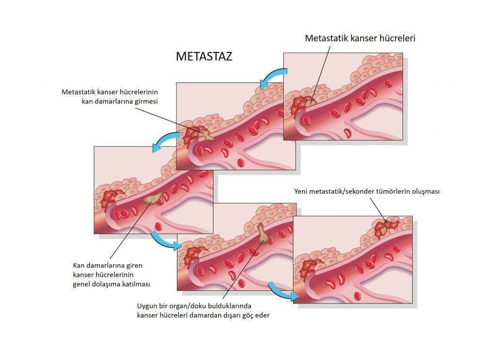 Metastaz nedir – kısaca – kanser nasıl yayılır 1024x719