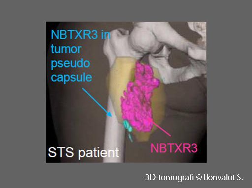 NBTXR3 nanopartikül lokal ileri yumusak doku sarkomu bonvalot 3 boyutlu topmografi