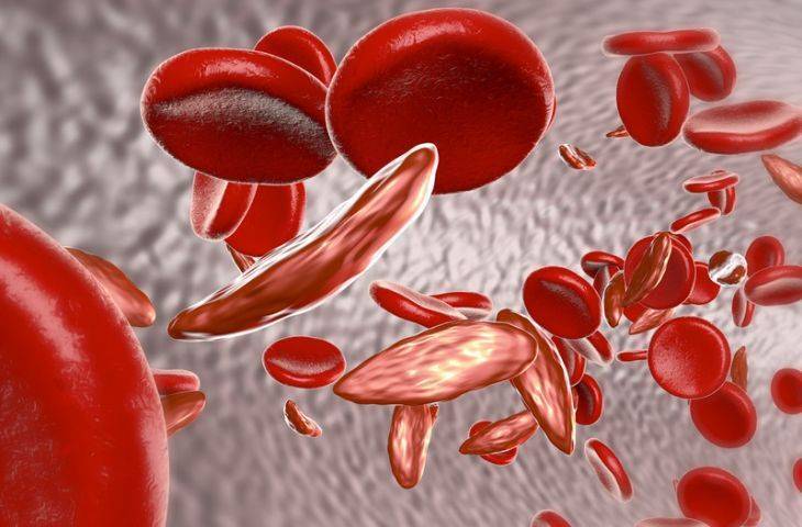Orak hücreli anemi ağrılı kriz tedavisi için L-glutamin FDA onayı aldı