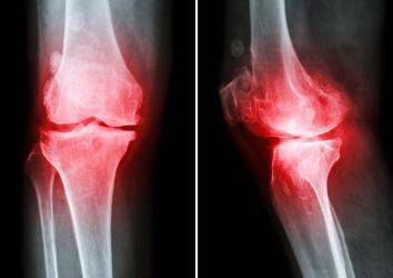 Osteoartrit, eklem kireçlenmesi neden kadınlarda erkeklerde daha fazla?