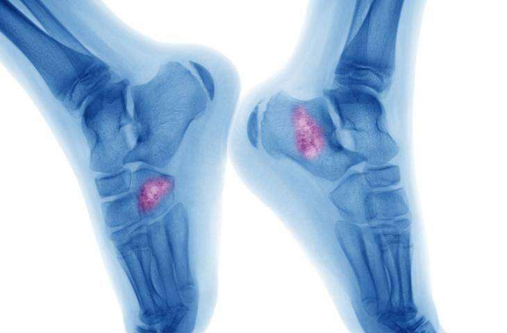 Osteosarkomda erken tanı ve tarama mümkün müdür? Nasıl teşhis edilir?