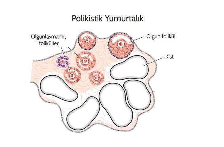 Polikistik Over Sendromu nedir, nasıl tedavi edilir?